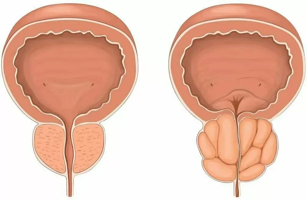 Zdrava prostata in prostatitis