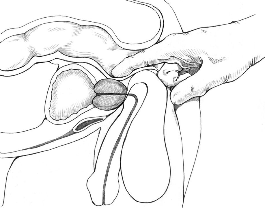 Masaža prostate je vključena v kompleks metod zdravljenja prostatitisa