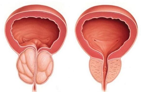 normalna in povečana prostata s prostatitisom